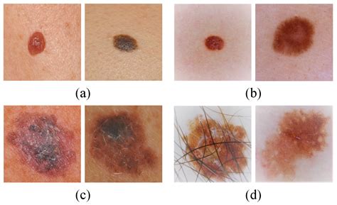 Different Melanoma Types