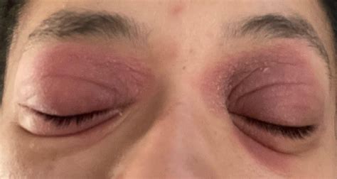 30F eyelid rash : r/DermatologyQuestions