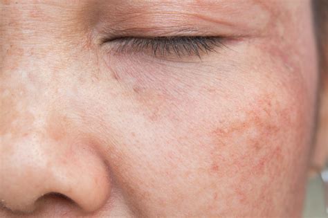 Common Skin Spots, Pictures, Causes & Treatment: Liver Spots