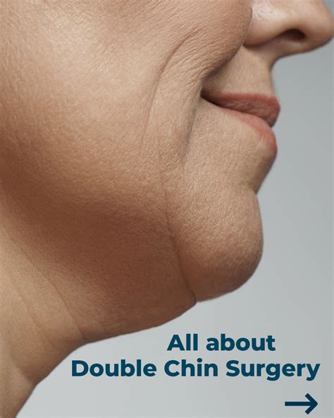 All About Double Chin Surgery – Aruba Plastic Surgery
