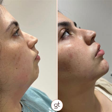 Before and After Gallery Dermal Fillers - Stunning Transformations