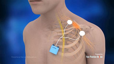 Peripheral Nerve Stimulation Video | Medical Video Library