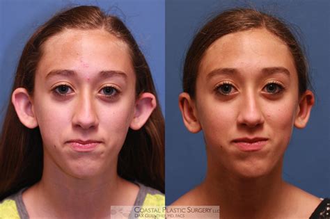 Ears After Spacers at Alan Koester blog