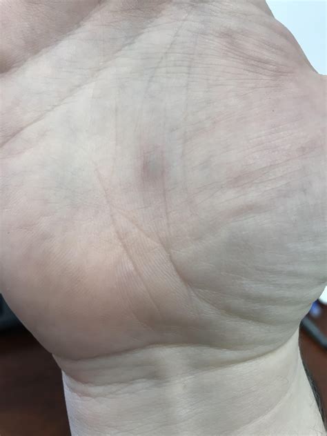Weird lump on palm. Woke up like this Sunday morning. No significant changes in two days ...