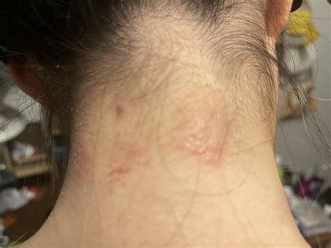 Does anyone know what these spots on the back of my neck are? They just showed up today. I've ...