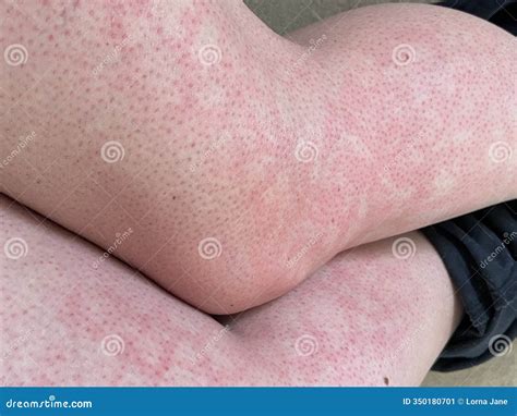 Mottled Skin Heat Rash Hives Allergy Knee Close-up Blotchy Mottled Red ...