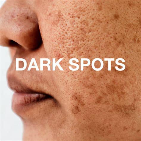 The Science Of Dark Spots | Causes & Remedies – Soulflower.in