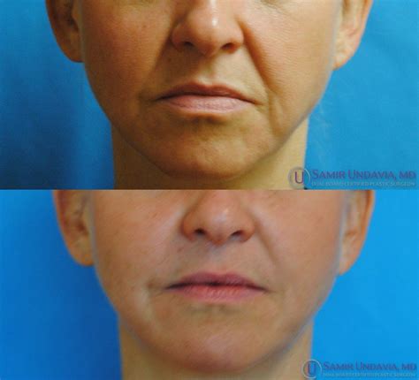 How Much Botox For Nasolabial Folds at Monica Baker blog