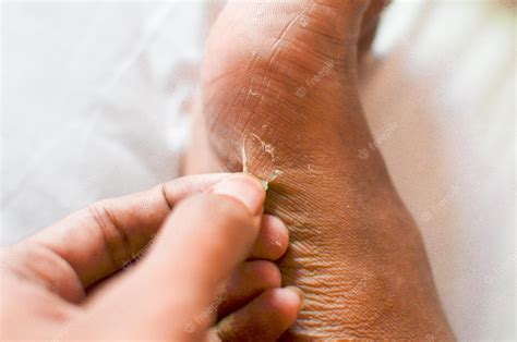 What Causes Peeling Skin On Feet