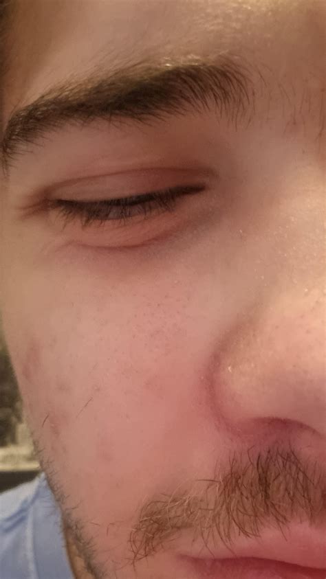 Why are my lower eyelids swelling? : r/Blepharitis