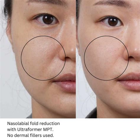 Ultraformer MPT: Unparalleled 2026 Skin Tightening Australia - Dr Davin Lim