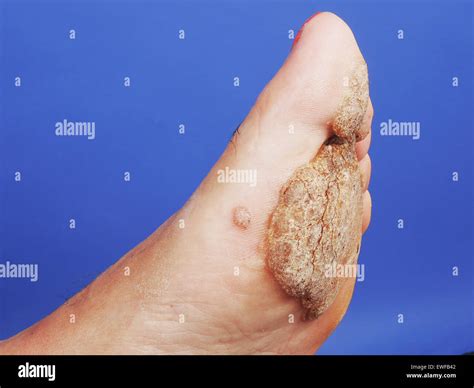 Plantar Wart Root Diagram