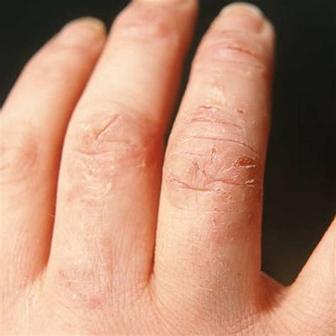 How To Remove Flaky Skin From Hands at Nicholas Mckillop blog
