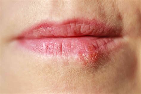 Cold Sores In Mouth