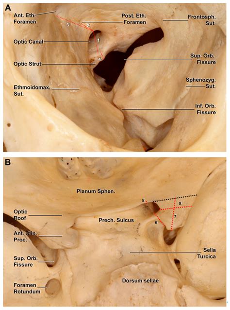 Middle Clinoid Process