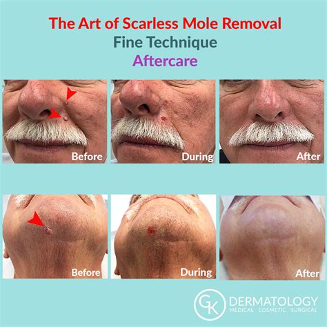 Mole Removal With Minimal Scarring at Donald Peterson blog