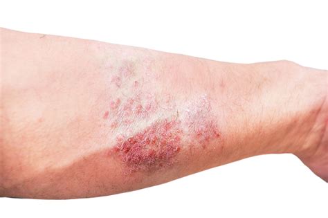 Eczema en adultos: causas, diagnóstico y tratamiento | FarmaLink.pe