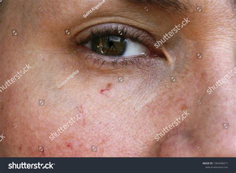Spider Veins Face: Over 131 Royalty-Free Licensable Stock Photos | Shutterstock