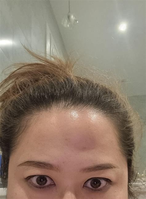what is this weird sudden bump on my forehead??? : r/medical