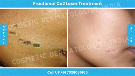 Fractional CO2 Laser Treatment in Mumbai, India | Laser Resurfacing - Cosmetic Dermatologist India