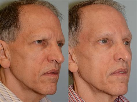 How Does Endoscopic Brow Lift Work at Karla Trent blog