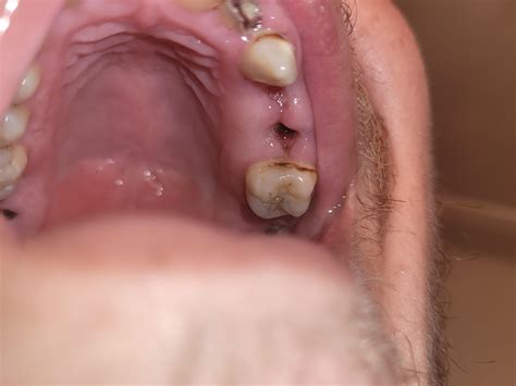 Burning sensation 6-7 days after extraction. : r/DentalDudes