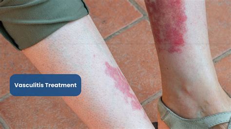 Vasculitis: A Closer Look at the Inflammation of Blood Vessels and its Implications