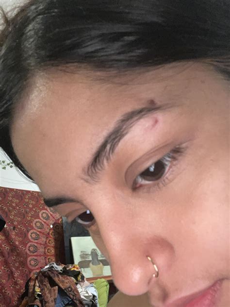 Eyebrow Piercing Scar How To Identify And Get Rid Of Keloids Caused By
