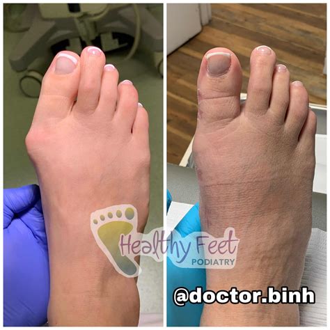 Minimally Invasive Bunion Surgery Wesley Chapel FL