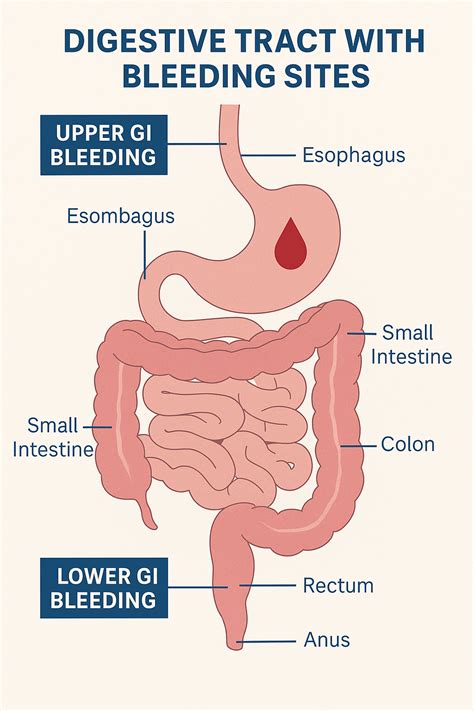 Intestinal Tract Bleeding Symptoms