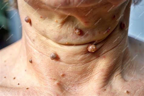 Skin tags on neck showing small flesh colored growths | Premium AI-generated image