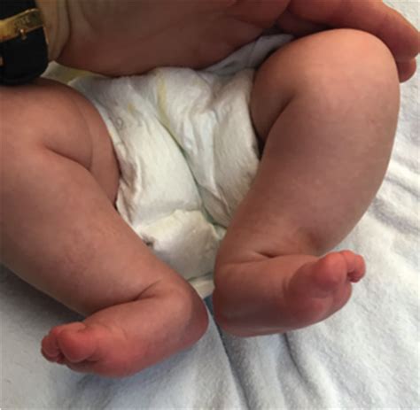 An Algorithmic Approach to the Congenital Vertical Talus - Journal of the Pediatric Orthopaedic ...