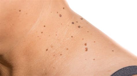 What causes skin tag? - Toronto Dermatology Centre