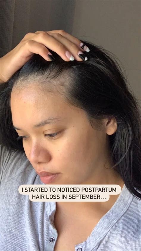 Postpartum hair loss transformation – Artofit