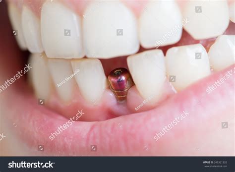 5,304 Woman Dental Healing Images, Stock Photos & Vectors | Shutterstock