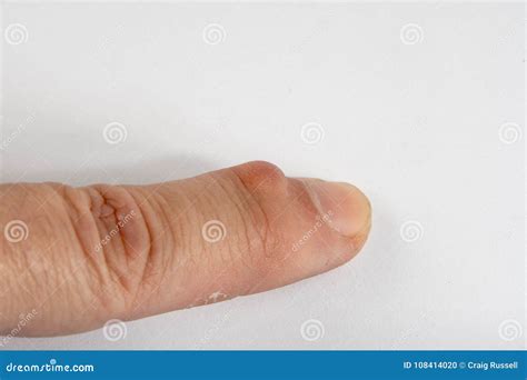 Hard Cyst On Finger