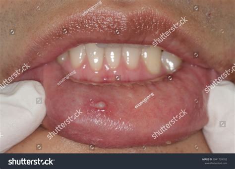 Lip Hpv