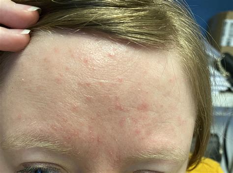 Heat Rash On Forehead Skin Rashes In Children | NHS Inform