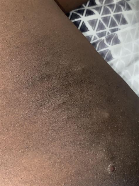 Bumps on inner thighs? : r/HidradenitisAIP
