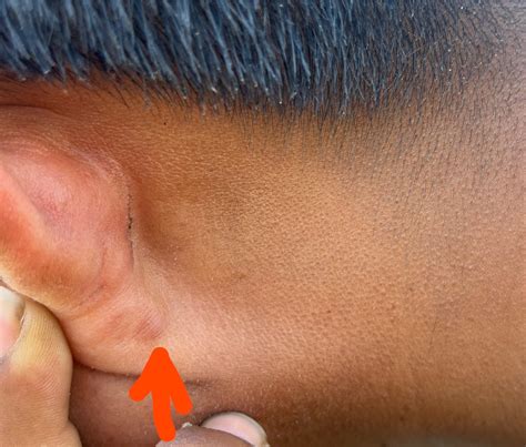 Lymph node behind ear : r/Lymph