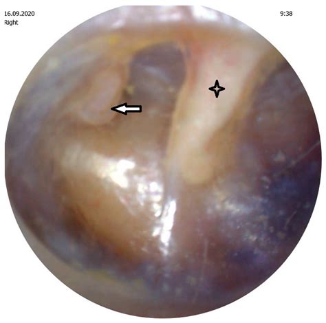 Pathogenesis of Retraction Pocket of the Tympanic Membrane—A Narrative Review