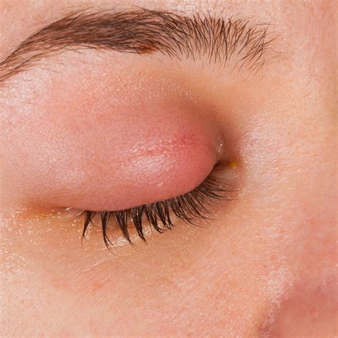 Blepharitis and Dry Eyes: What’s Causing Your Sore, Itchy Eyelids? - CHEC