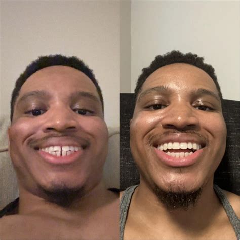 Was 3 trays from the end of treatment and a canine stopped tracking so ...