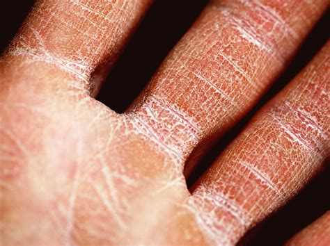 Feet Have Peeling Skin at Linda Fujiwara blog