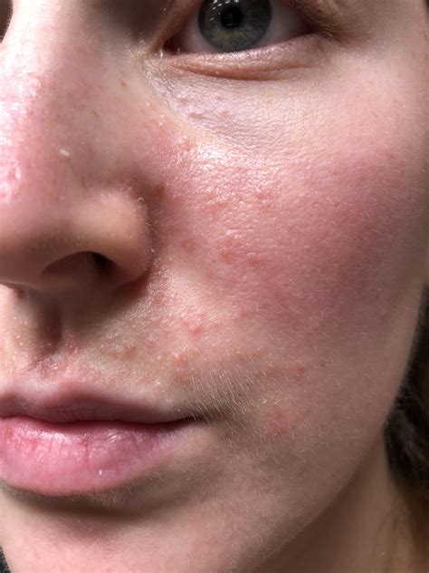 Skin colored bumps on face