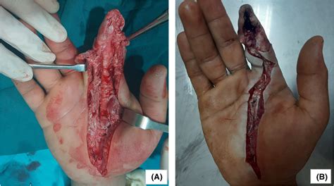 High‐pressure injection of paint into the hand: A small injury with ...