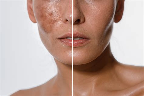 Rated #1 Best Chemical Peel Level II (MelanX) Near Me