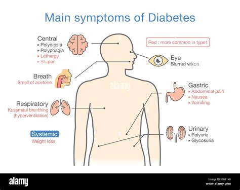 Illustration of main symptoms of Diabetes Stock Vector Image & Art - Alamy