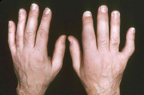 Pictures of Psoriatic Arthritis: What It Looks Like