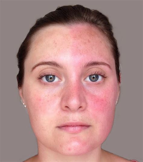 The Harlequin sign | Thorax